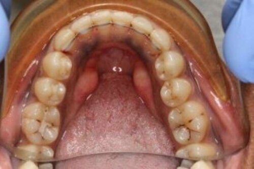 Fixed wire retainers placed on lower front teeth