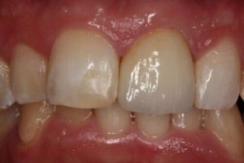Left central tooth is an empress crown
