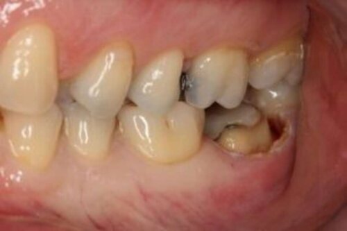Lengthen tooth with waterlase iplus laser treatment