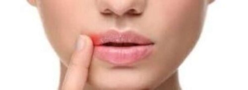 Lips of woman with cold sore