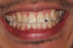 Post treatment 300x200