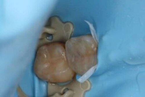 Restored teeth no drilling no needles no pain