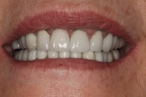 Single tooth implant 10 300x200