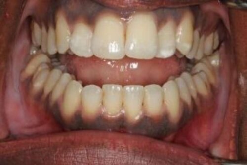 Straight front teeth