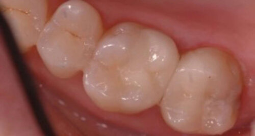Teeth with metal filling removed