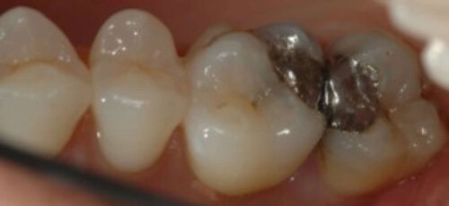 Teeth with metal filling