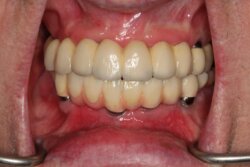All teeth implants After 2