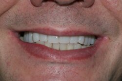 All teeth implants After 5