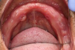 All teeth implants Before 3