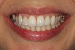 Cosmetic bonding after 14