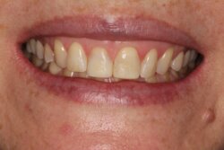 Cosmetic bonding after 18