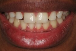 Cosmetic bonding after 2