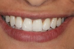 Cosmetic bonding after 20
