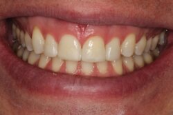 Cosmetic bonding after 4