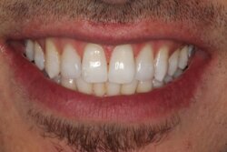 Cosmetic bonding after 6