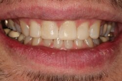 Cosmetic bonding after 8