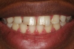 Cosmetic bonding before 1