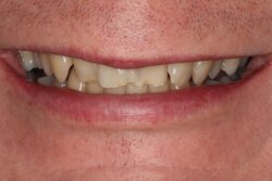 Cosmetic bonding before 15
