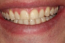 Cosmetic bonding before 3