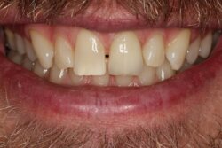 Crowns After 1