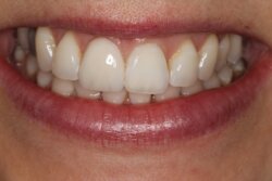 Crowns After 2