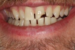 Crowns Before 1