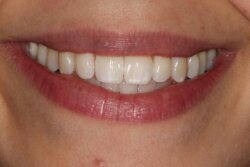 Invisalign After 1