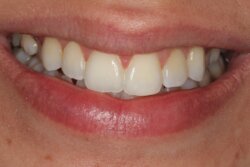Invisalign After 2