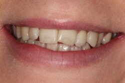 Invisalign Before 3
