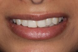 Invisalign Before 4