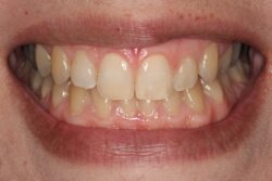 Lingual Braces After 2