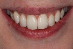 Lingual Braces After 4