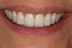 Lingual Braces After 5