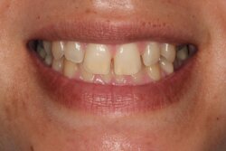 Lingual Braces Before 2