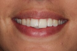 Lingual Braces Before 3