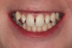 Lingual Braces Before 4