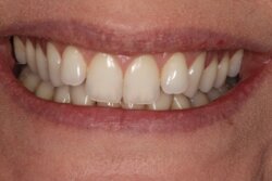 Lingual Braces Before 5
