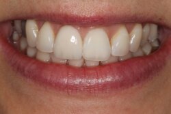 Porcelain veneers After 4
