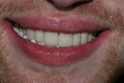 Porcelain veneers After 6
