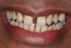 Porcelain veneers Before 1