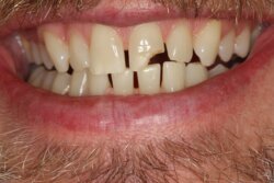 Porcelain veneers Before 5