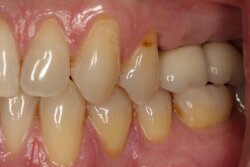 Several teeth implants After 2