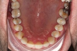 Several teeth implants After 3