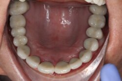 Several teeth implants After 5
