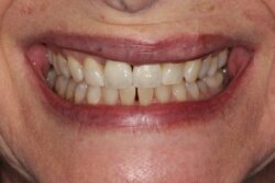 Single tooth implant After 7