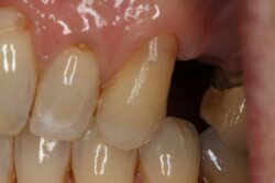 Single tooth implant Before 1