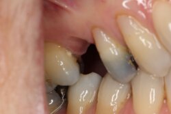 Single tooth implant Before 2