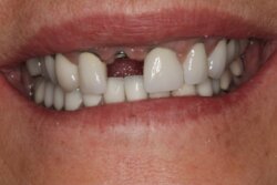 Single tooth implant Before 5