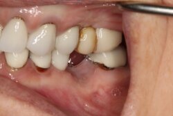 Single tooth implant Before 6
