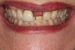 Single tooth implant Before 7